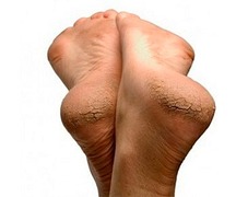 Виды трещин на стопах ног