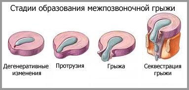 Протрузии дисков позвоночника лечение украина