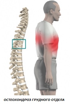 Грудной остеохондроз тяжело. Межпозвонковый остеохондроз грудного отдела. Грудной отдел позвоночника th8-th11. Остеохондроз th3-th6. Остеохондроз th6 - th10.