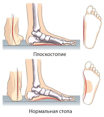 Боль в ступнях ног: причины и лечения